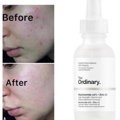 The Ordinary- Niacinamide 10% + Zinc 1% 30Ml